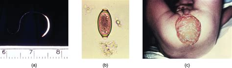 Rectal Prolapse Trichuris