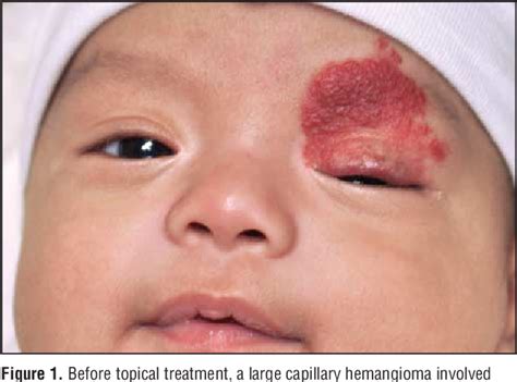 Pdf Topical Treatment For Capillary Hemangioma Of The Eyelid Using β