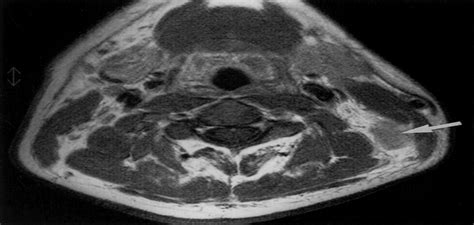 Mri Of Tuberculous Cervical Lymphadenopathy Journal Of Computer
