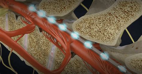 Spinal Cord Stimulation Procedures By Experienced Neurosurgeons