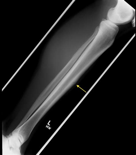 Femur Bone Anatomy X Ray