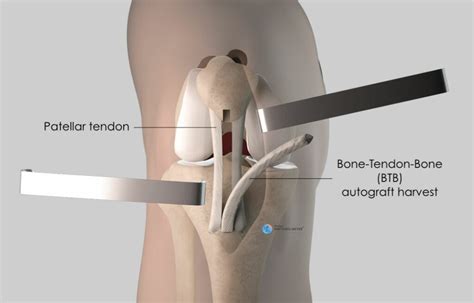 Anterior Cruciate Ligament Reconstruction Kenneth Jones Doctor