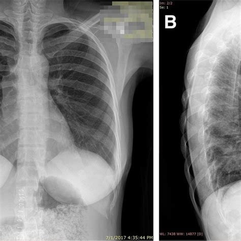 A And B One Month Follow Up Chest X Ray Completely Normal Download