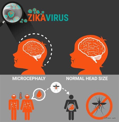 Microcephaly And Zika Virus Things You Should Know Global Healthcare