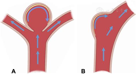 Underlying Mechanism Of Hemodynamics And Intracranial Aneurysm