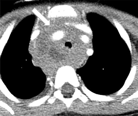 Burkitt Mediastinal Lymphoma Axial Ct In A 6 Year Old Girl With