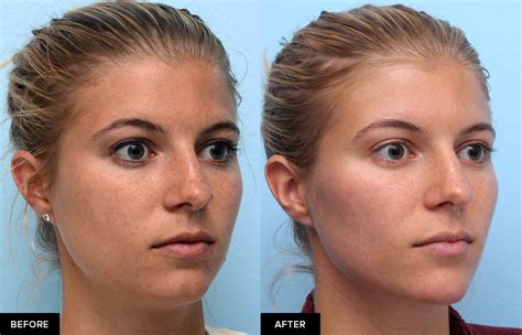 Defining The Jaw And Jawline With Fillers In San Francisco Dr David