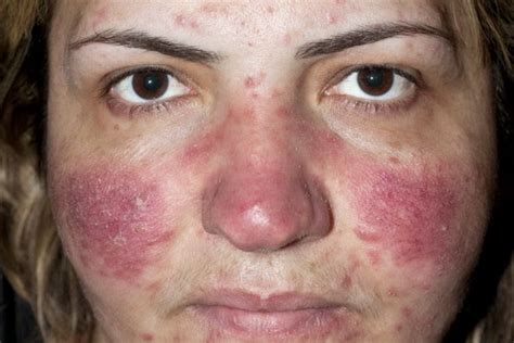Types Chronic Skin Conditions