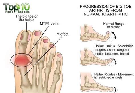 Big Toe Arthritis Diagram Arthritisprevention Arthritis Arthritis In Big Toe Yoga For Arthritis