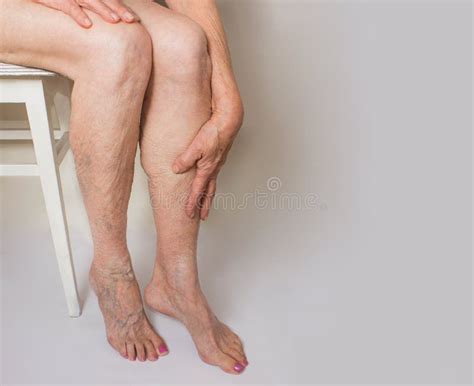 Varicose Veins On A Female Senior Legs The Structure Of Normal And Varicose Veins Stock Image