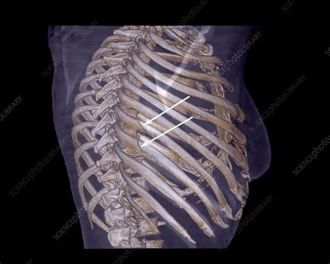 Rib Fractures 3d Ct Scan Stock Image C0403122 Science Photo Library