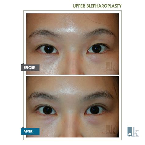 Asian Double Eyelid John Kang Md Facs Jk Facial Plastics