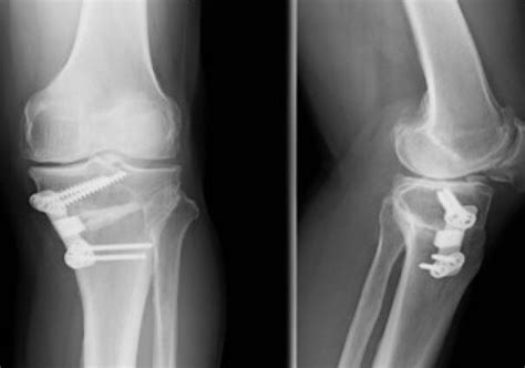Valgus Proximal Tibial Osteotomy Using Puddu Plate In Left Knee