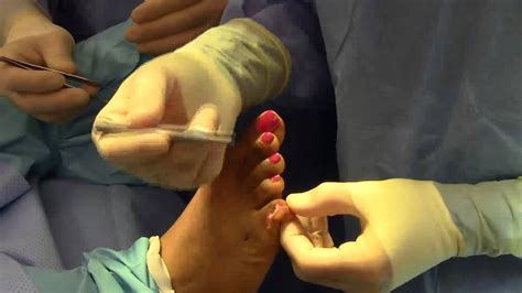 Chiropractic Treatment For Hammer Toes Jeanette Bocchini