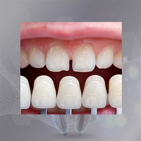 Prótesis Dental Carillas De Porcelana Ideales Para Mejorar La Estética