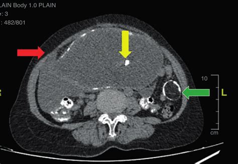 CT Image Of Chronic Mature Cystic Teratoma With Focal Defect On Right