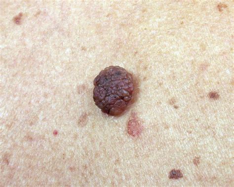 Intradermal Nevus Stock Image C0169991 Science Photo Library