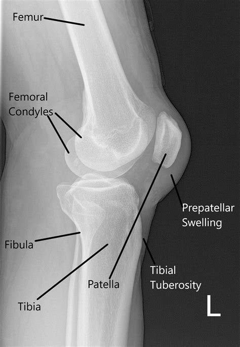 Case Study Left Knee Tear Management In 55 Yr Old Female