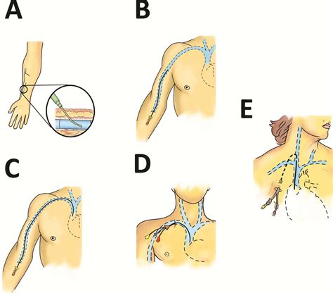 Figure 1 From Navigating Venous Access A Guide For Hospitalists