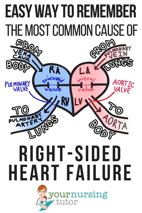 Easily Remember The Most Common Cause Of Right Sided Heart