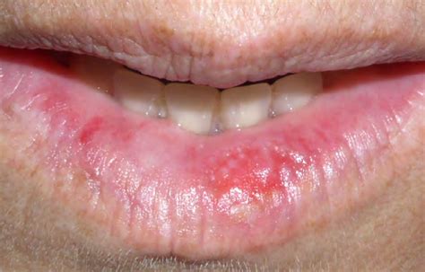 White Spots On Bottom Lip