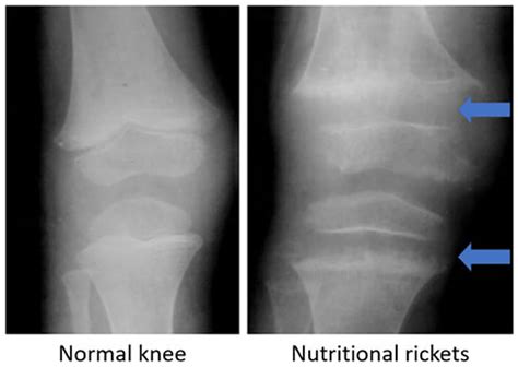 Radiographs Of A Normal Knee Left And A Knee With Nutritional Rickets