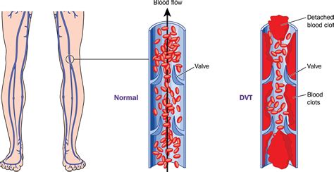 Dvt Deep Vein Thrombosis Signs Symptoms Prophylaxis And Treatment