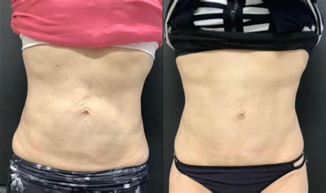 exilis ultra skin tightening before and after photos patient 34 washington dc mi skin