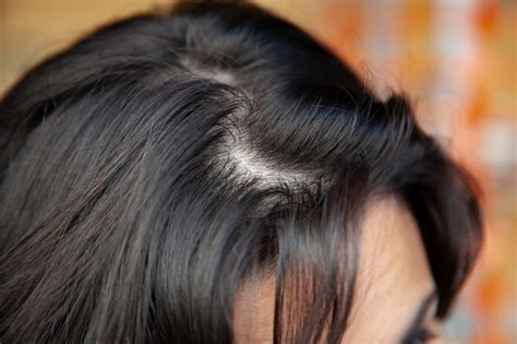 What Does Thinning Hair Look Like And How To Stop It Revela