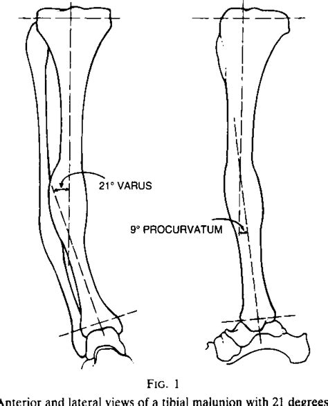 Figure 1 From Oblique Osteotomy For The Correction Of Tibial Malunion