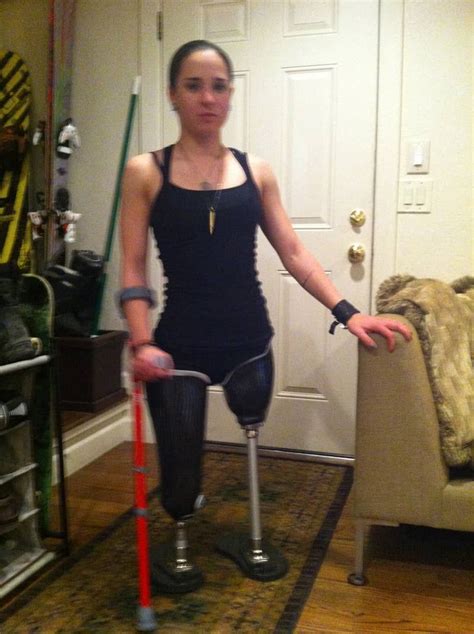 Amputee Lady Amputee Model Prosthetic Leg Spinal Cord Injury Borg