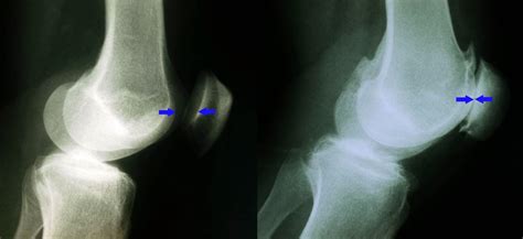 X Rays Of A Normal Knee And An Arthritic Knee