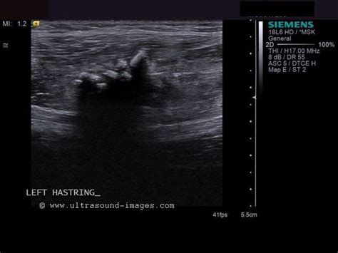 Supreme How To Understand Thyroid Ultrasound Results What Is Technical