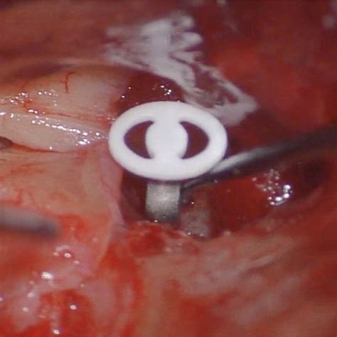 Total Ossicular Reconstruction With Cartilage Reconstruction The