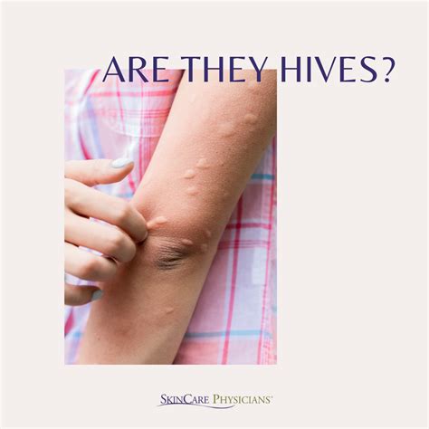 How To Spot Hives And What To Do Skincare Physicians