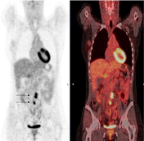 Coronal 18 Fdg Pet And Fused 18 Fdg Pet Ct Images Demonstrating Avid 18