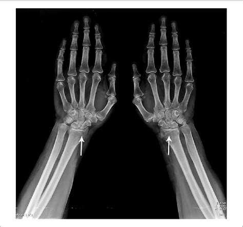 Plain Radiogram Of Both Hands Including Distal Forearms Shows Bilateral