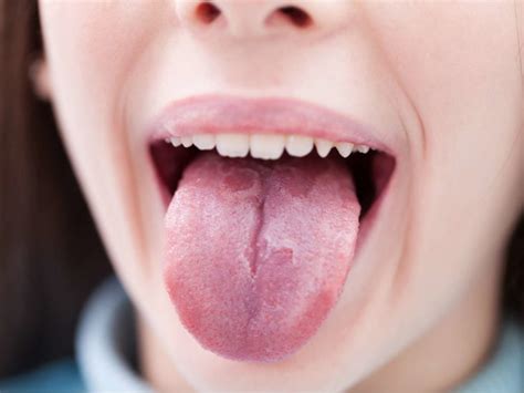 49 Dark Spots On Tongue 