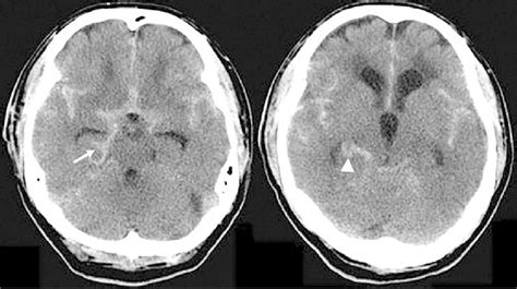 Brain Computed Tomography Showing Typical Subarachnoid Hemorrhage And
