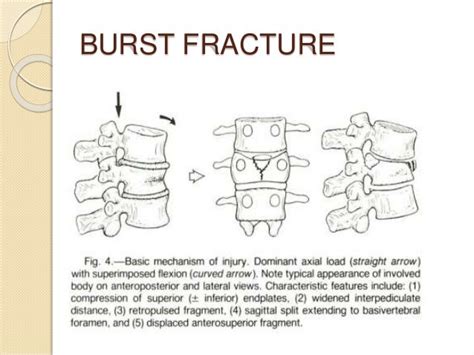 Thoracolumbar Burst Fracture