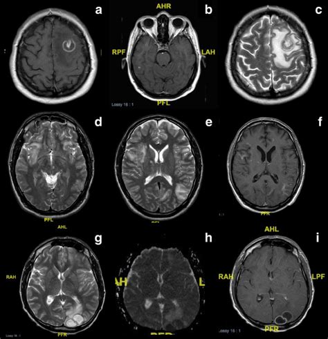 Ac Toxoplasma Encephalitis Brain Mri Of A 47 Year Old Woman With