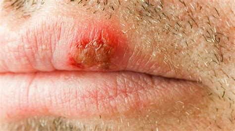 Hiv Mouth Sores What They Look Like And How To Treat Them
