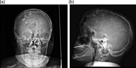 Osteolitic And Osteoblastic Lesions Of The Skull Bmj Case Reports