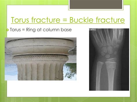 Ppt Introduction To Pediatric Orthopaedics Common Fractures