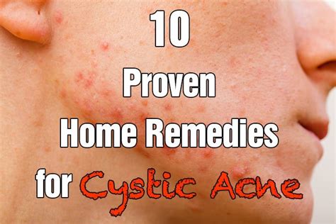 10 Proven Home Remedies For Cystic Acne Healthy Focus