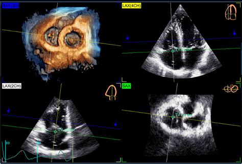 Frontiers Reference Ranges Of Tricuspid Annulus Geometry In Healthy