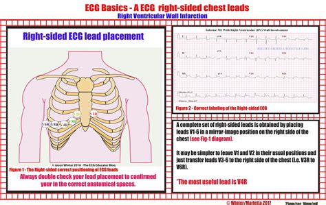 Right Sided Ecg Lead Placement Em Im Cardiology Grepmed