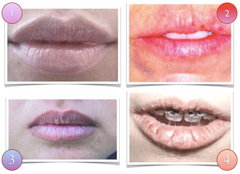 What Are Blue Purple Lips A Symptom Of Sitelip Org