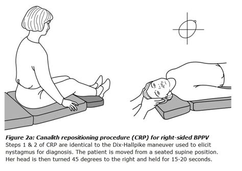 Canalith Repositioning Procedure For Bppv Vestibular Disorders
