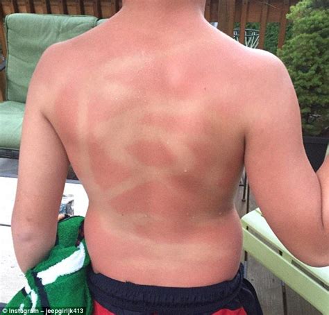 Are These The Worst Sunburn Fails Ever Bad Sunburn Fails Sunburn